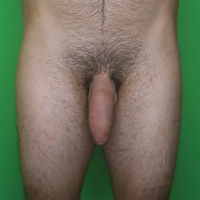 Enhancement_after_12